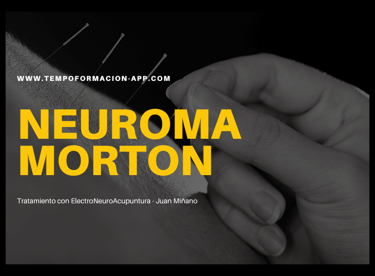 caso-clinico-neuroma-morton-y-electroneuroacupuntura